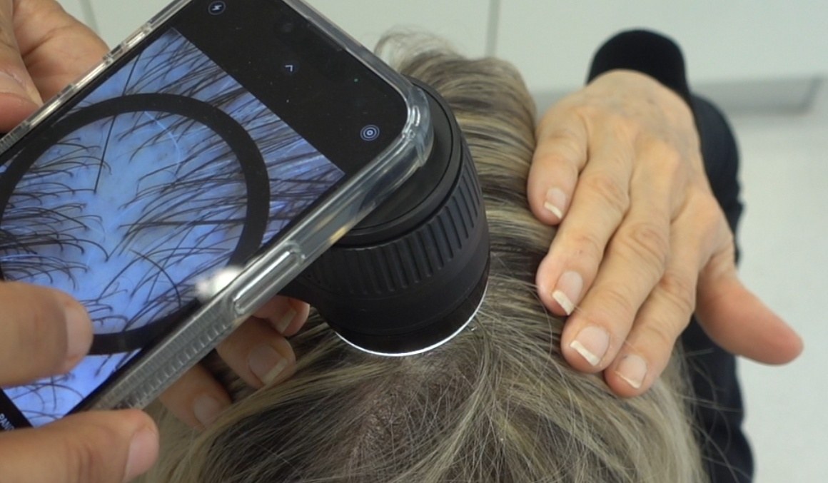 Dermoscopic scalp image acquisition with a smartphone and attachment